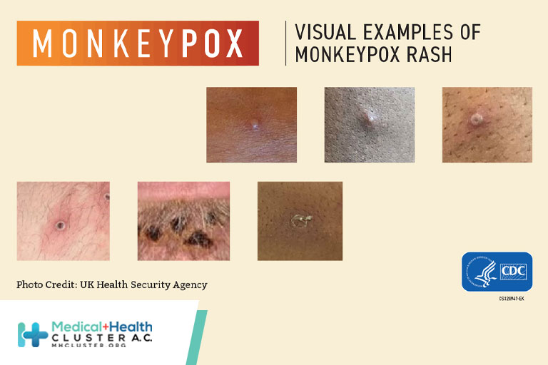 Monkeypox Virus Infection in Humans across 16 Countries — April–June 2022